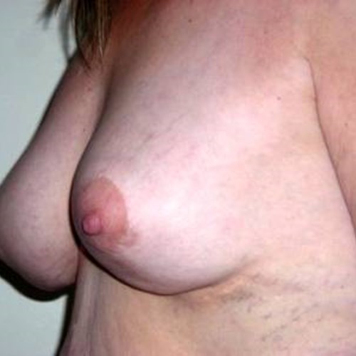 Breast Surgery Post 2