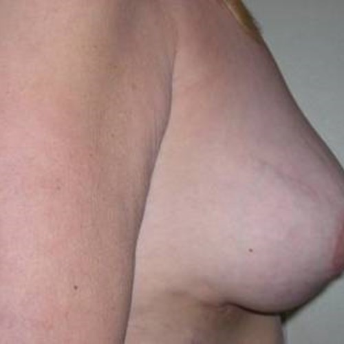 Breast Surgery Post 3