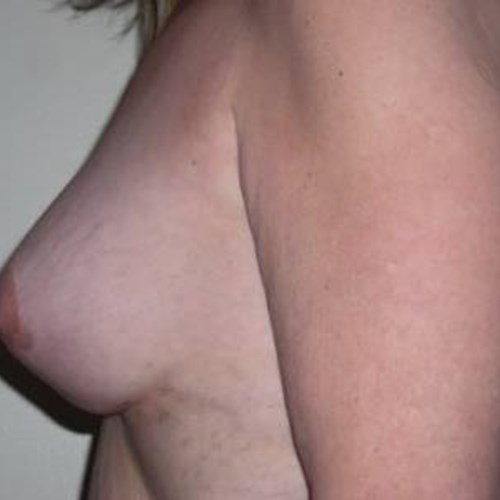 Breast Surgery Post 4