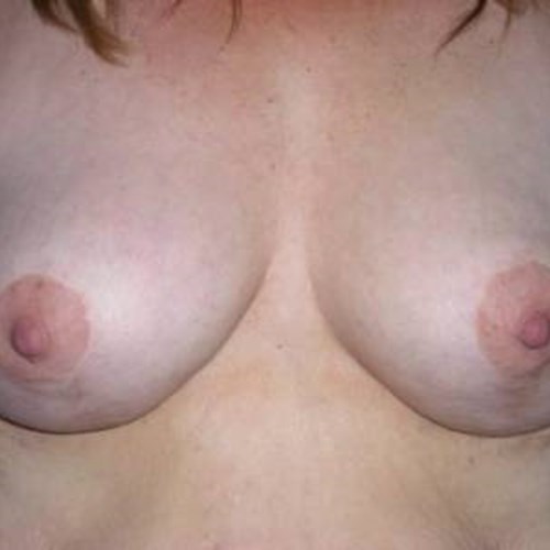 Breast Surgery Post 5