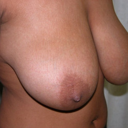 Breast Surgery Pre 2