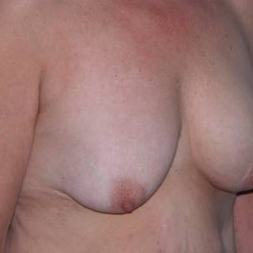 Breast Surgery Pre 3