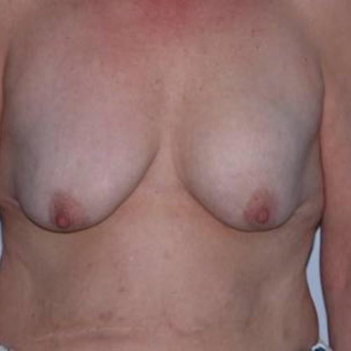 Breast Surgery Pre 4