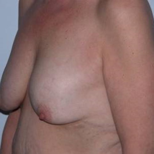 Breast Surgery Pre 6
