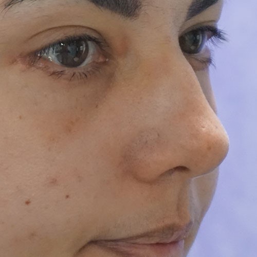 Post-Lower-Eyelid-Blepharoplasty-3.jpg