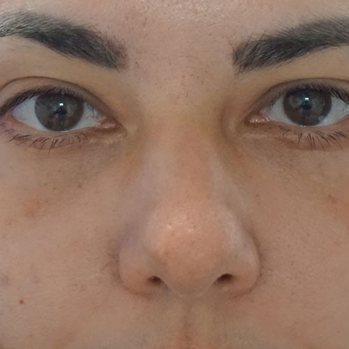 Post-Lower-Eyelid-Blepharoplasty-1.jpg